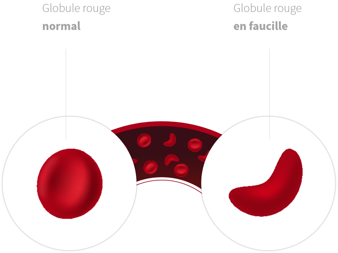 Schématisation de l'effet de la drépanocytose sur les globules rouges